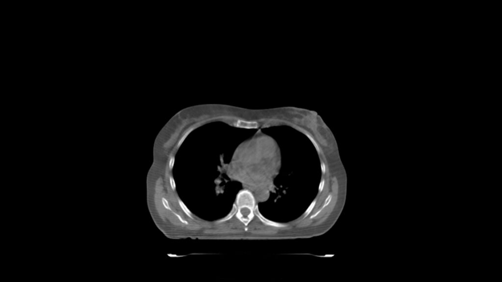 ClearRT L Breast Standard Axial