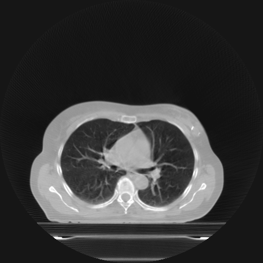 ClearRT Lung Axial