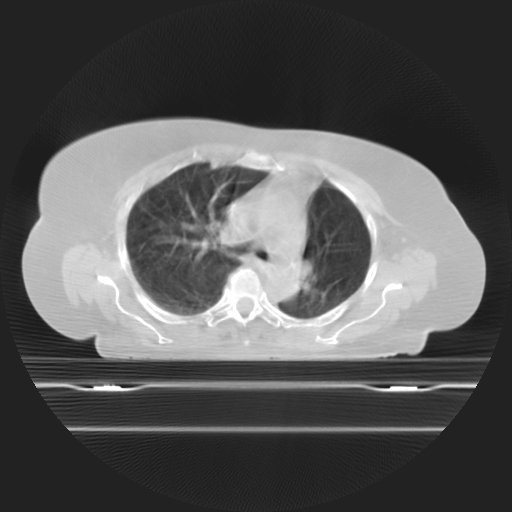 ClearRT Lung Axial