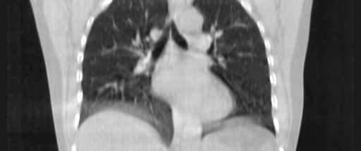 ClearRT Lung Coronal