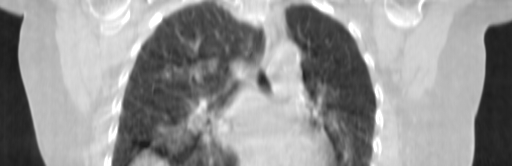 ClearRT Lung Coronal