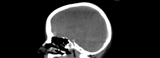 ClearRT Menigioma Sagittal