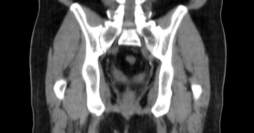 ClearRT Prostate Bed 66GY Coronal