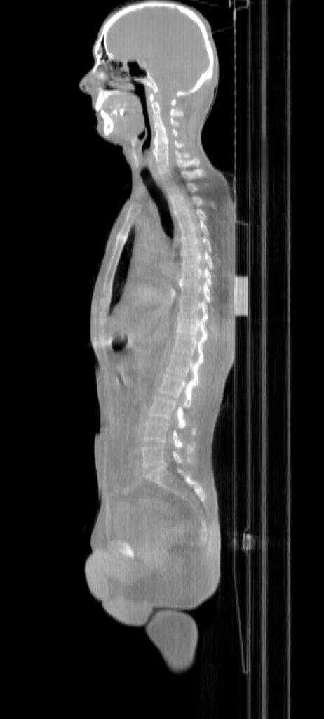 ClearRT TBI Sagittal