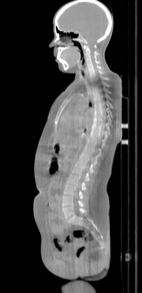 ClearRT TMI Sagittal