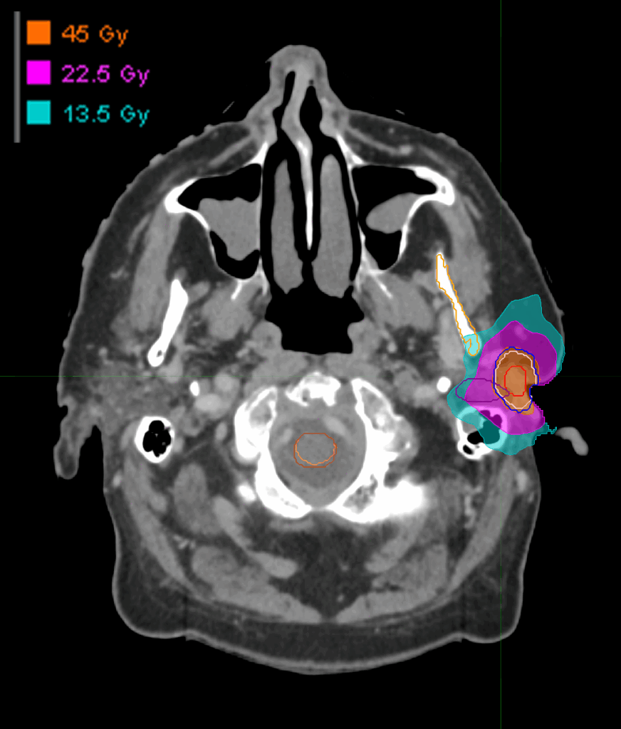 Dose_Auditive duct_axial - FOR SCREEN