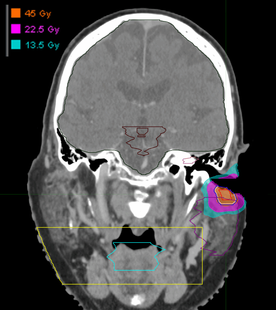 Dose_Auditive duct_coronal