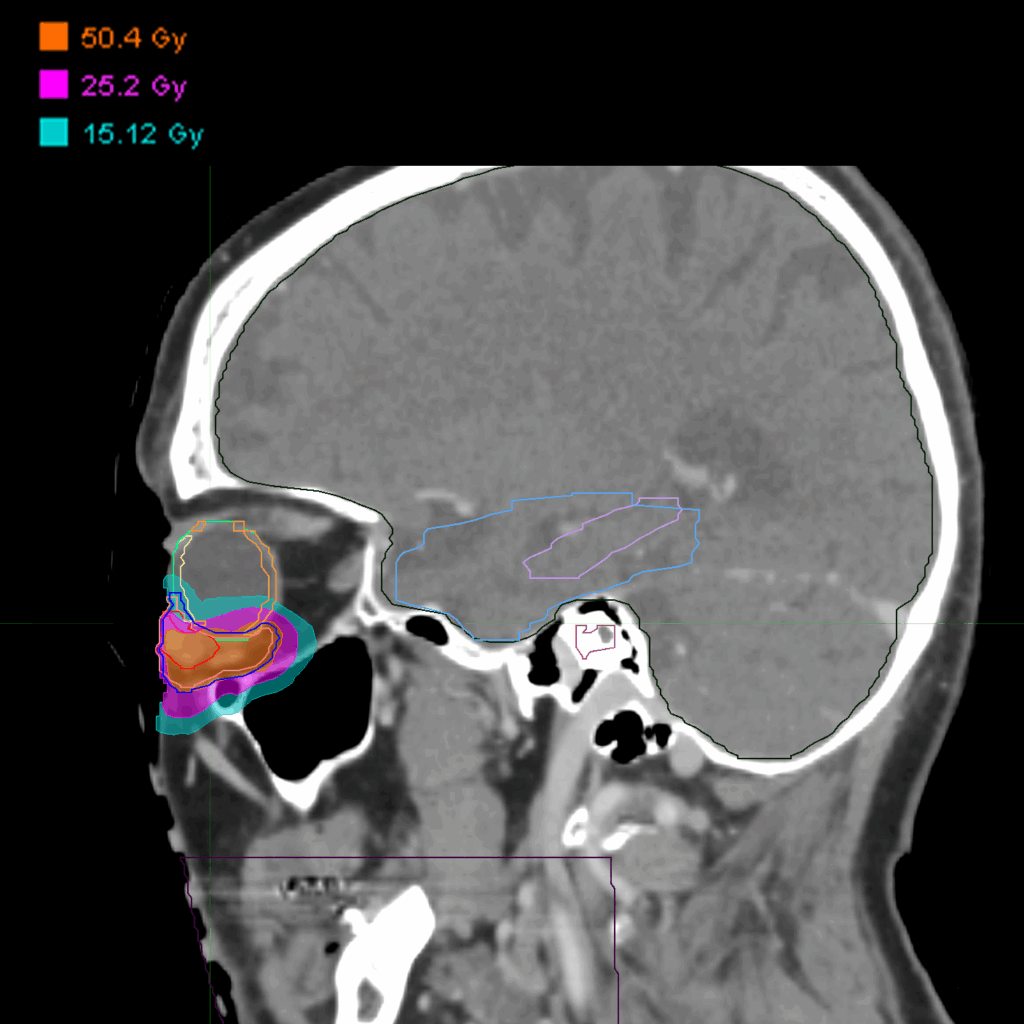 Dose_Periocular_L_Sagital