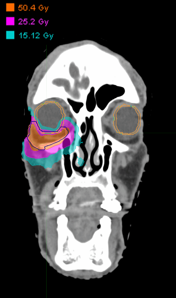 Dose_Periocular_R_coronal