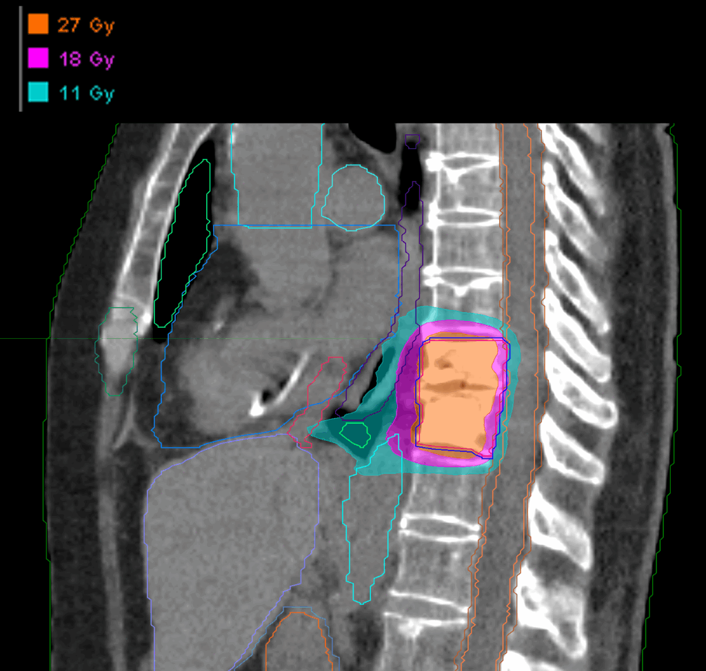 Dose_Sagital_T10-T11