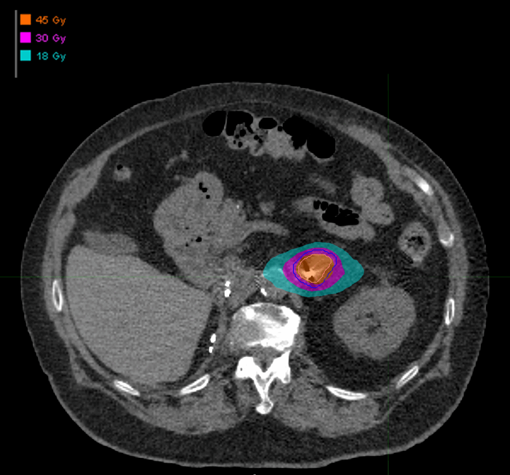 Dose_axial_Adrenal
