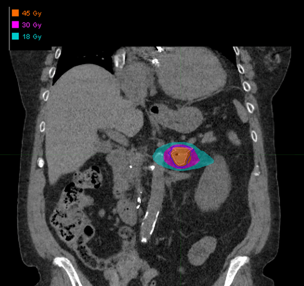 Dose_coronal_Adrenal