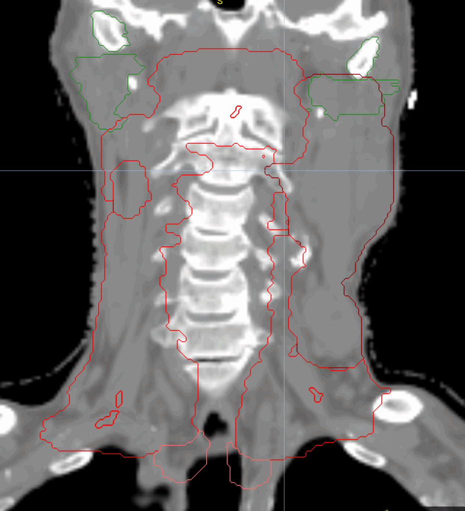 HN CT coronal