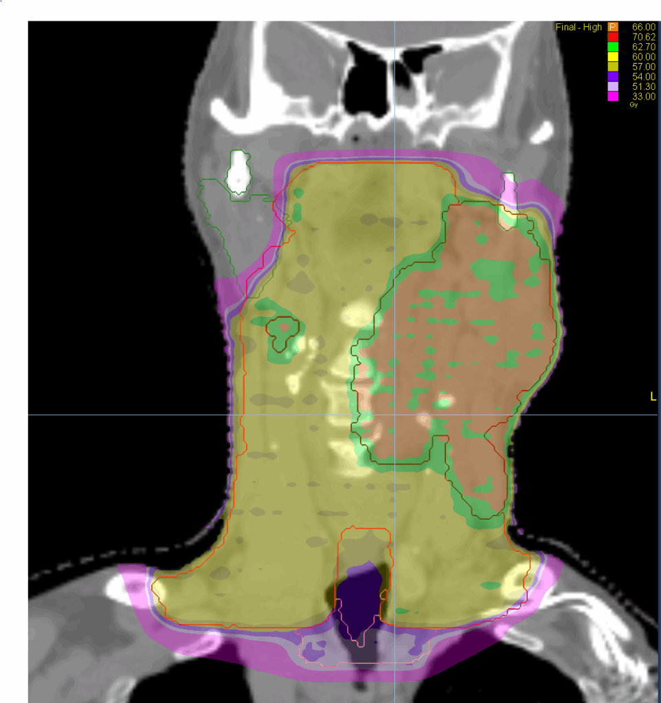 HN dose coronal