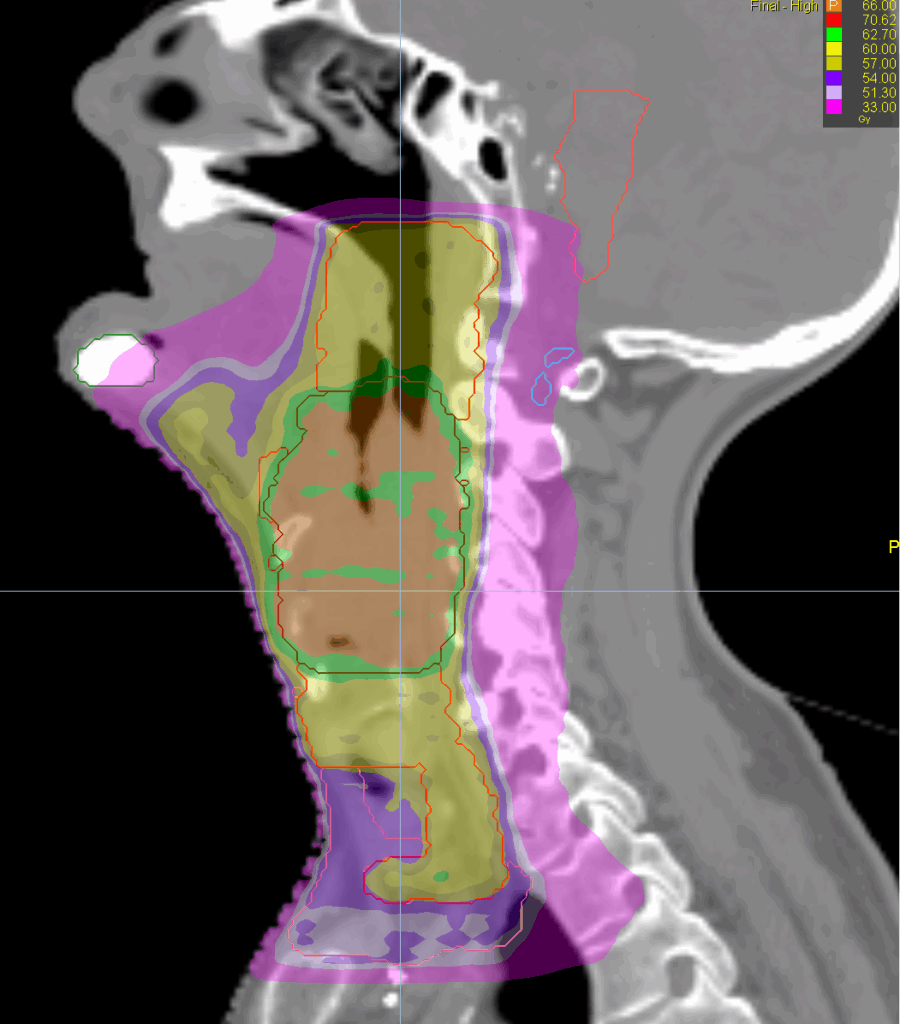 HN dose sag FOR SCREEN