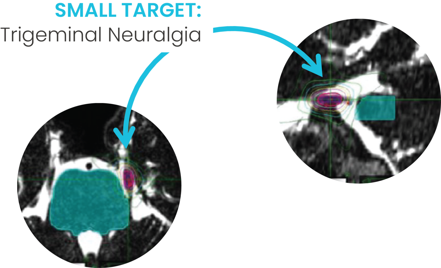 Radiosurgery Accuray