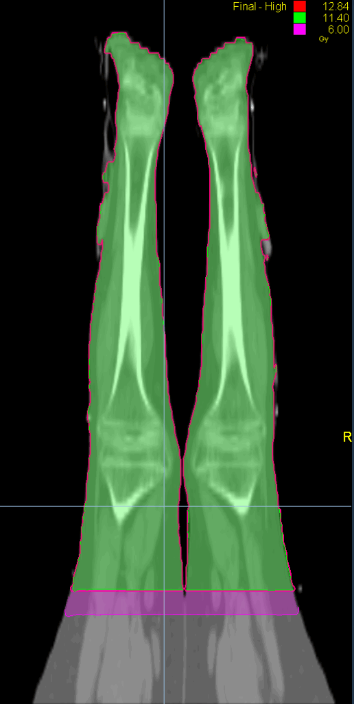 TBI FFS coronal dose