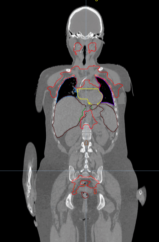 TMI CT coronal
