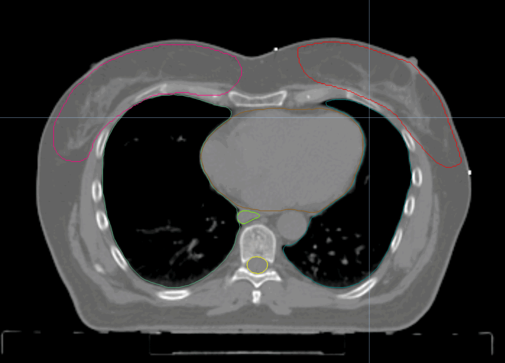 bilateral breast CT axial