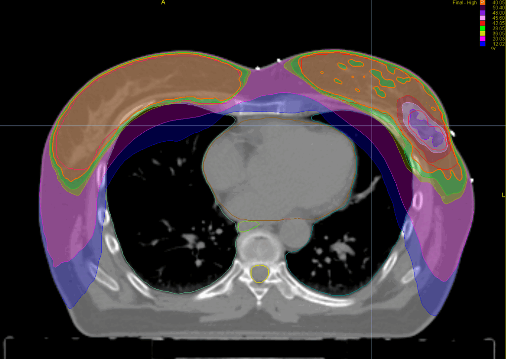 bilateral breast dose axial - FOR SCREEN