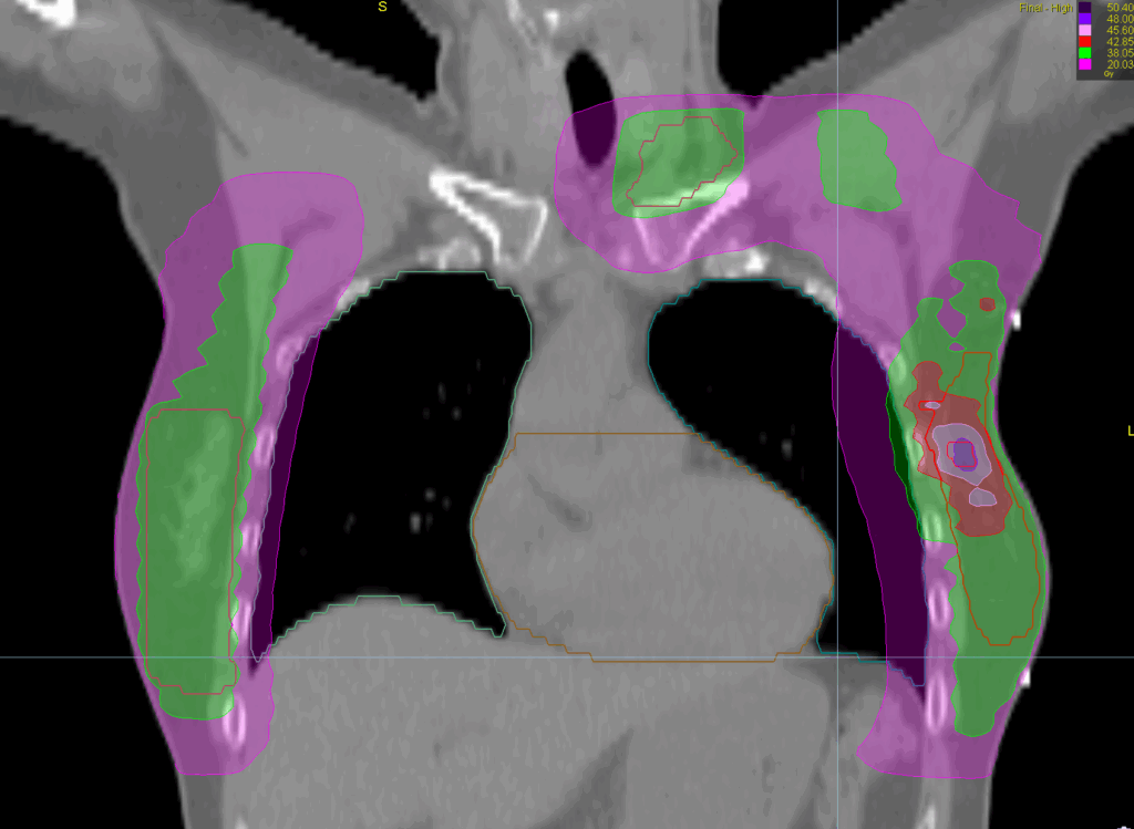 bilateral breast dose coronal - FOR SCREEN