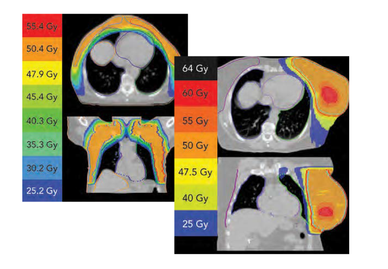 Breast IMRT