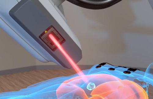 CyberKnife Lung