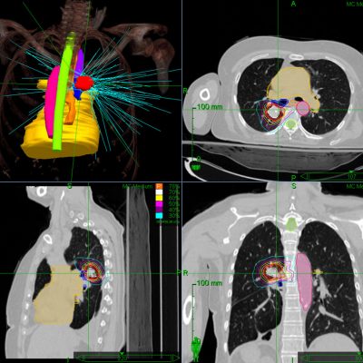 ck-lung-central-1 CyberKnife central lung