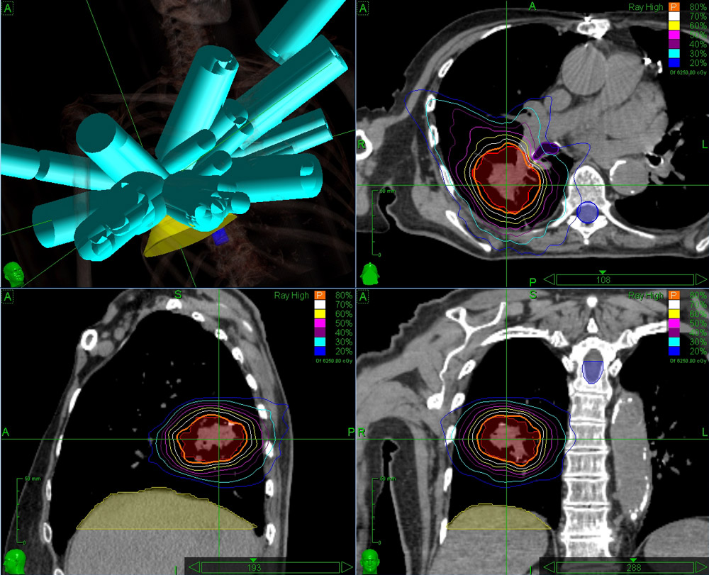 CyberKnife central lung