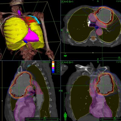 CyberKnife central lung