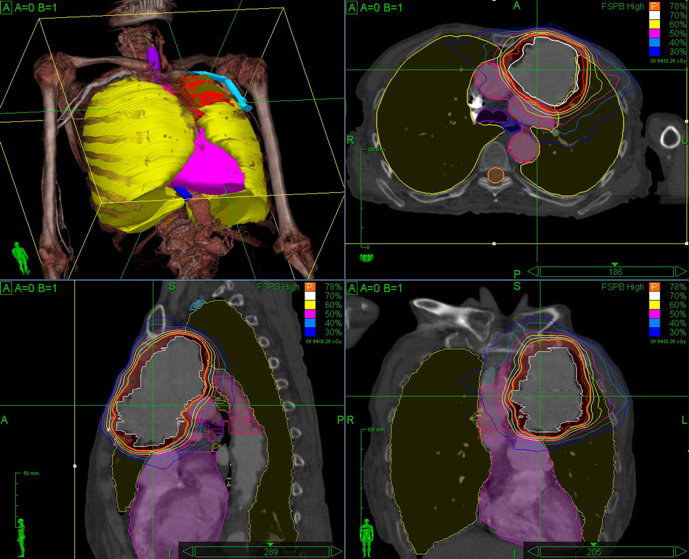 CyberKnife central lung