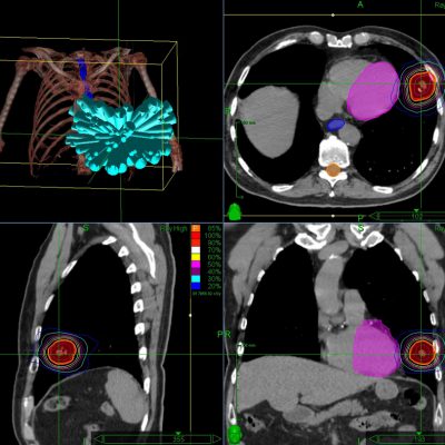 CyberKnife chest wall