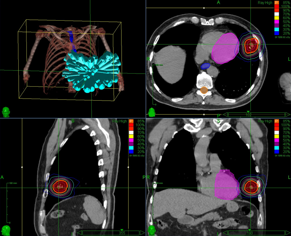 CyberKnife chest wall
