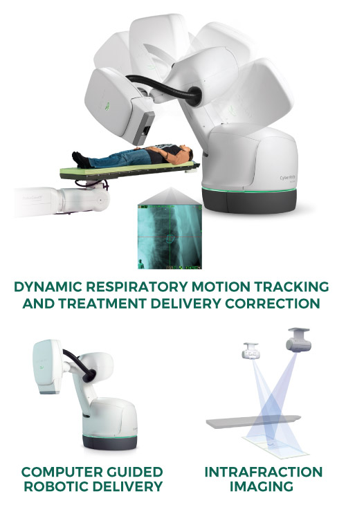 Accuray CyberKnife Dynamic SBRT Lung Tracking