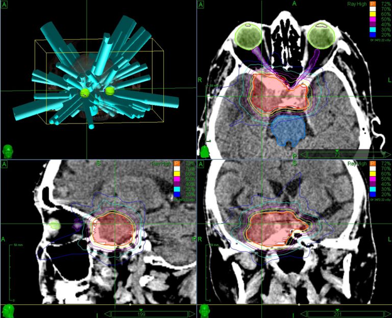 Brain Stereotactic Radiosurgery with CyberKnife Accuray