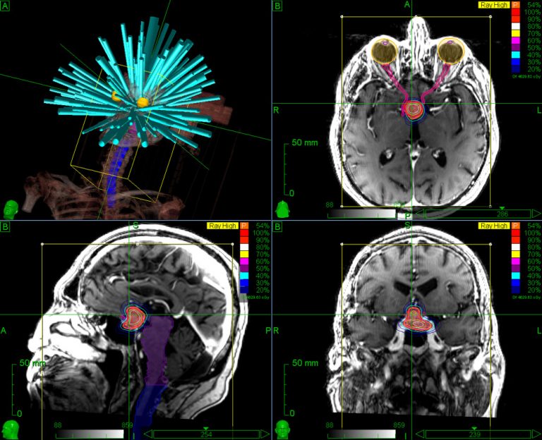 Brain Stereotactic Radiosurgery with CyberKnife Accuray