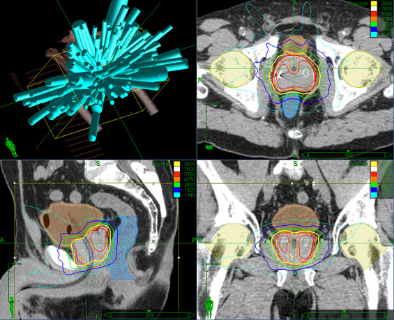 CyberKnife Prostate