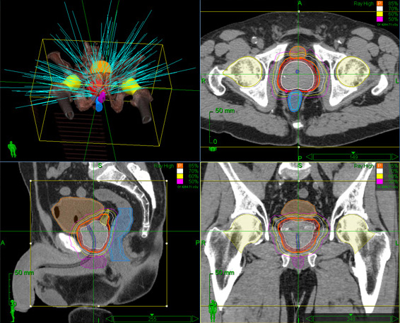 CyberKnife Prostate