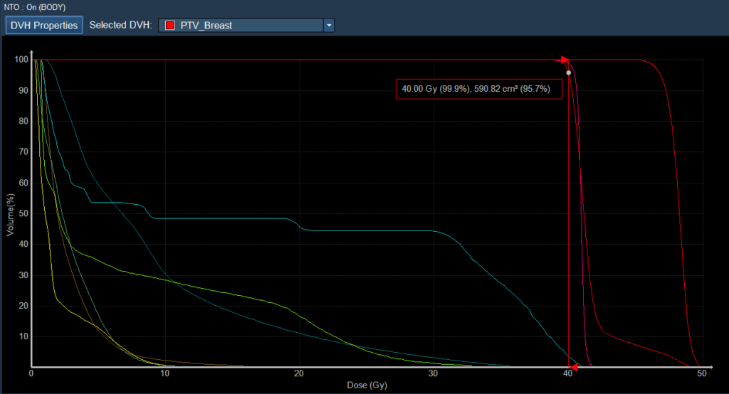 complex left breast DVH