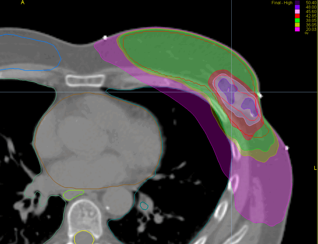 complex left breast SIB axial dose