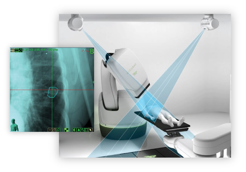 Illustration of frameless stereotactic targeting for lung cancer with the CyberKnife System from Accuray
