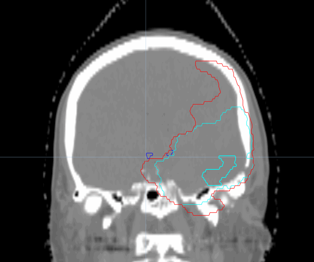 meningioma coronal CT