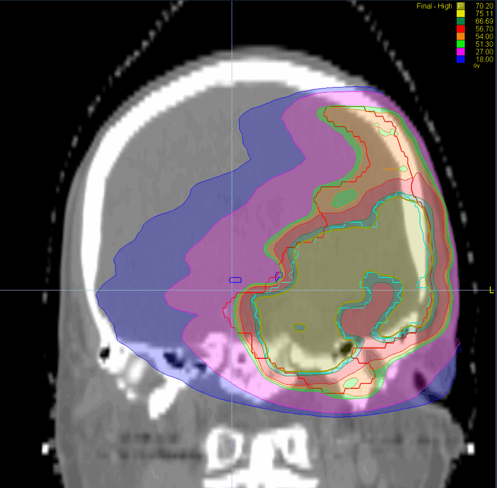 meningioma coronal dose