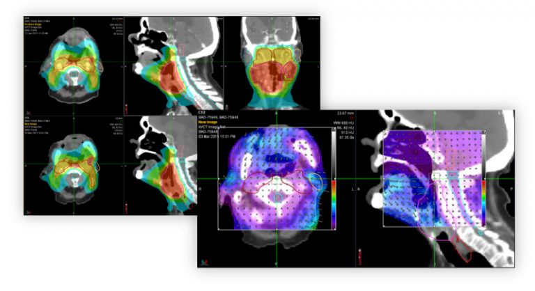 Precision Radiotherapy Treatment Planning - Accuray