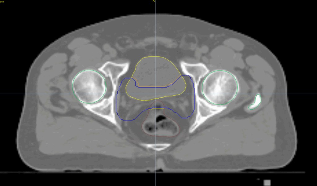 prostate bed axial CT