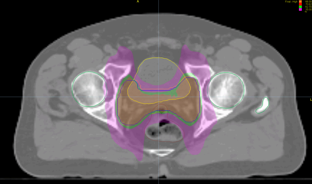 prostate bed axial dose