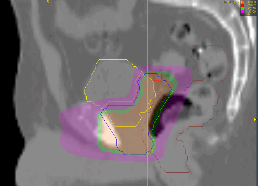 prostate bed sag dose