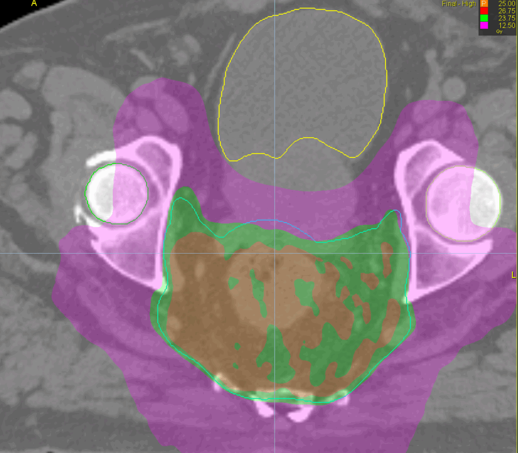 rectum sbrt dose axial