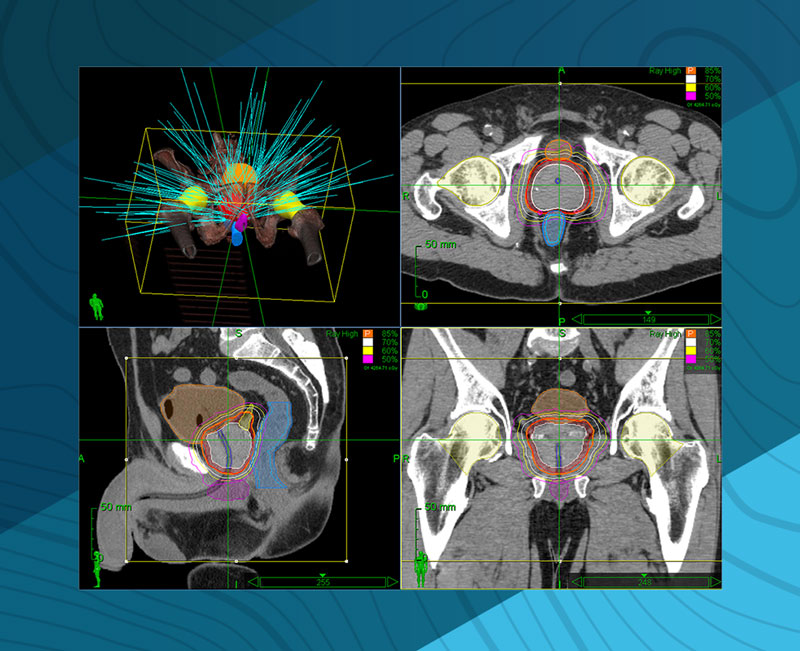 Accuray CyberKnife clinical SBRT