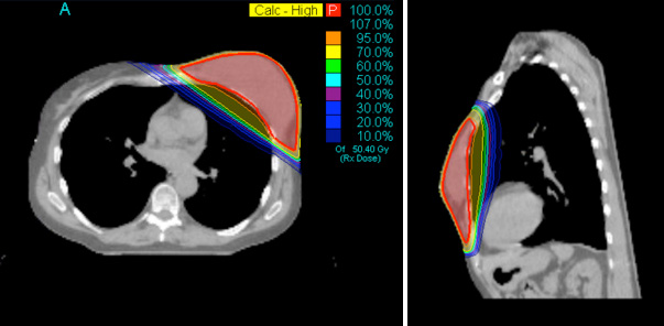 TomoDirect Breast 3DCRT